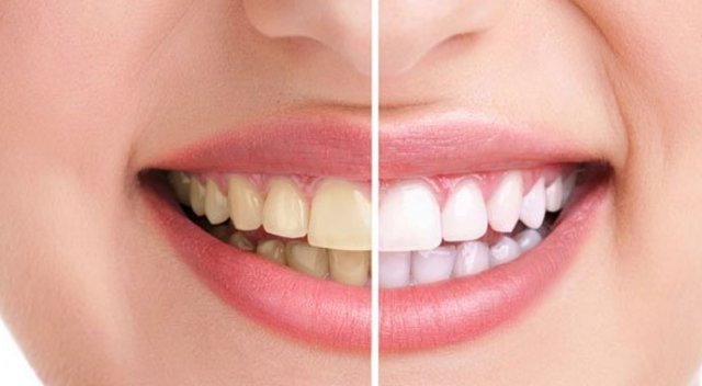 sararmış dişler gülüşünüzü etkiler